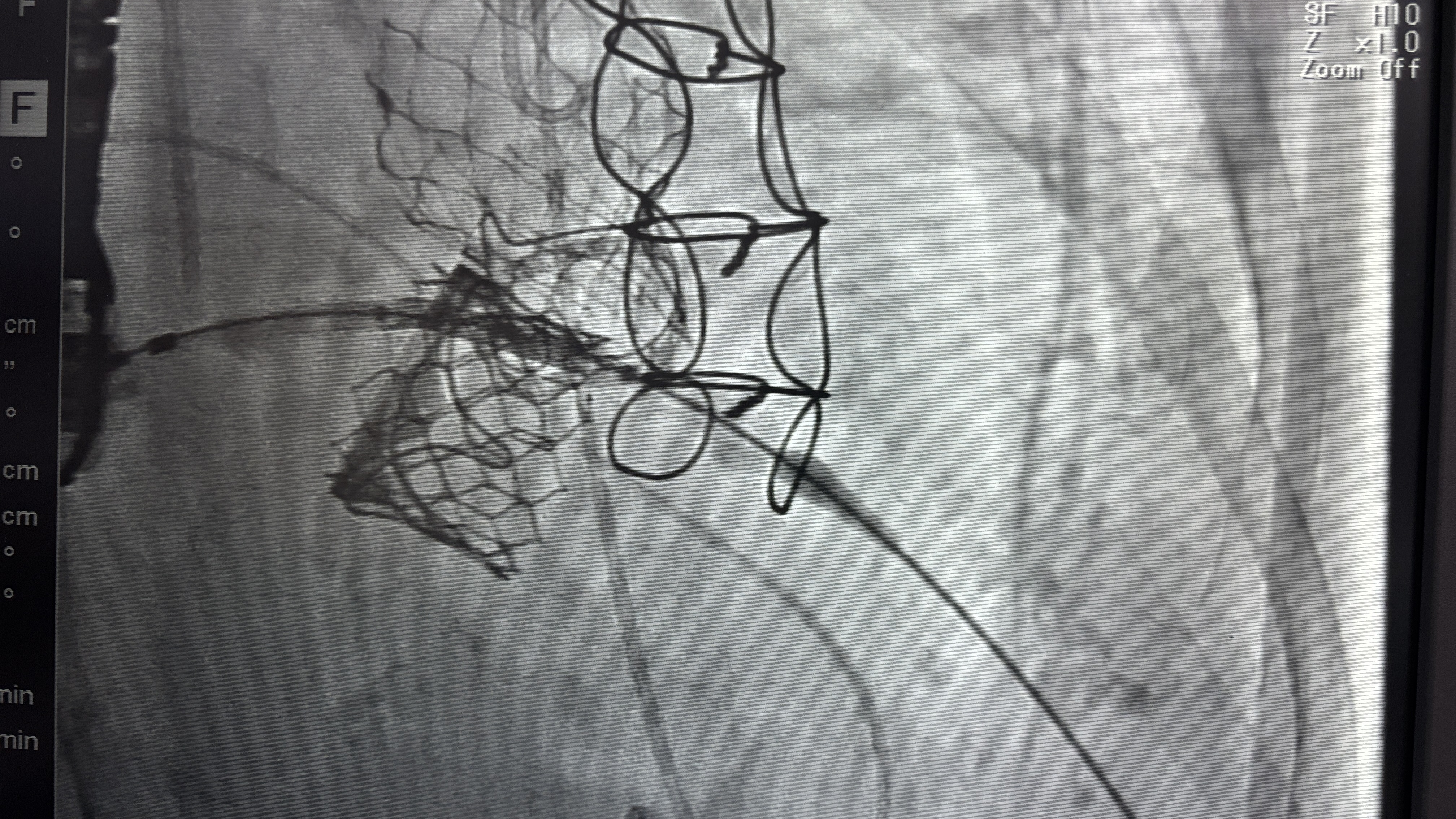 一天換了四個瓣膜